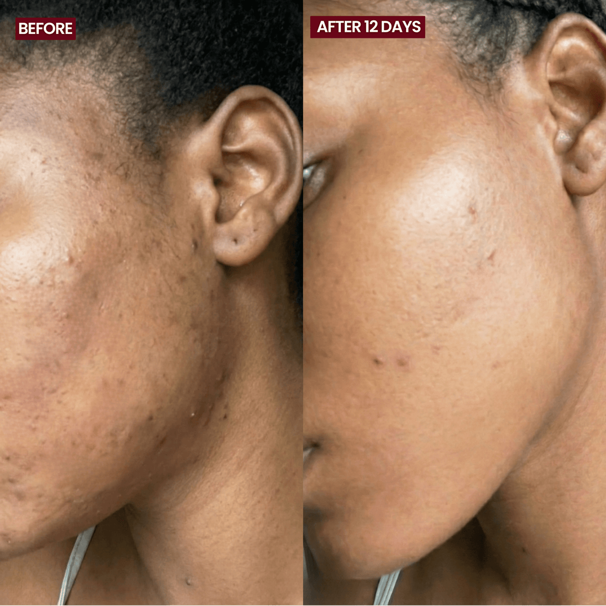 The Acne & Redness Reset Powder - TRY SIDR®